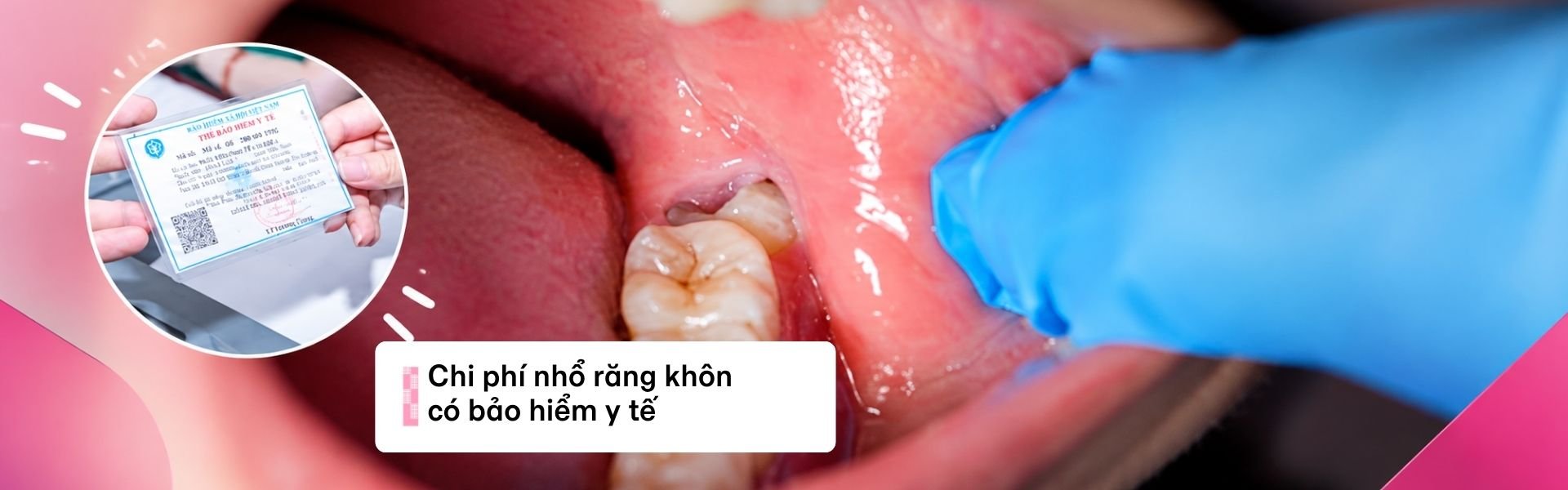 Chi phí nhổ răng khôn có bảo hiểm y tế 2026: hết bao nhiêu tiền?