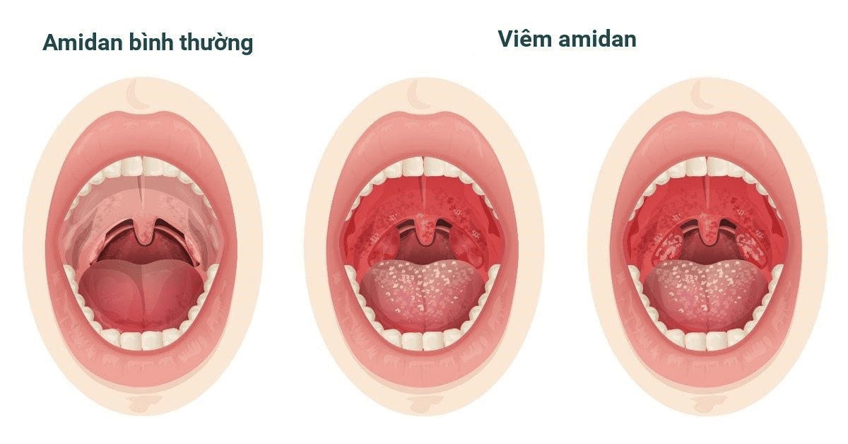 chi phí cắt amidan có bảo hiểm y tế