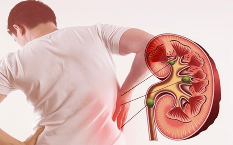 Tìm hiểu chi phí tán sỏi thận chưa tính BHYT