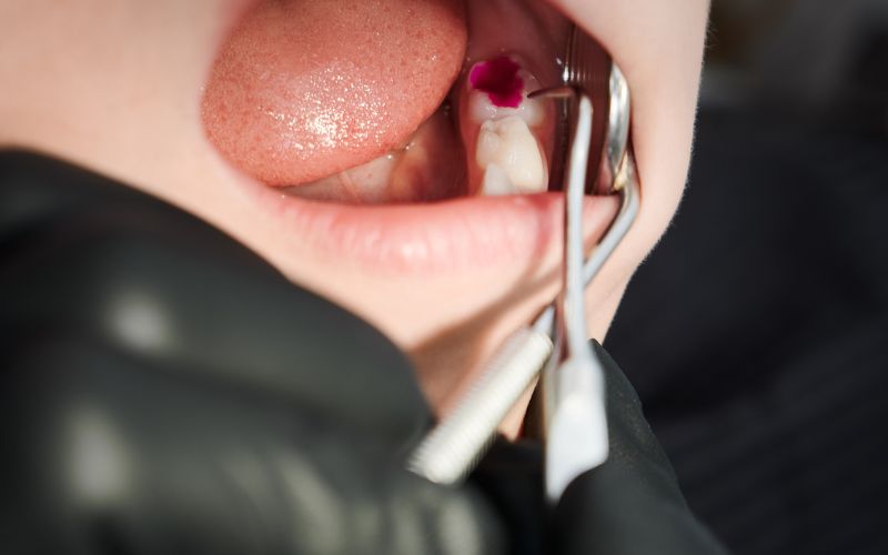 Tìm hiểu chi phí nhổ răng khôn có bảo hiểm y tế mới nhất hiện nay