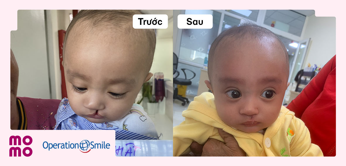 Em nhỏ kém may mắn có cơ hội được phẫu thuật chữa lành nụ cười