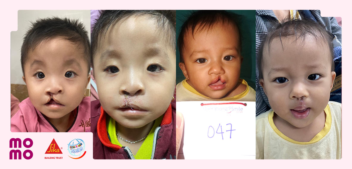 Mang đến 80 nụ cười lành lặn cho các em nhỏ kém may mắn