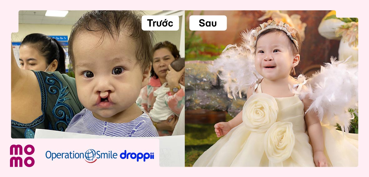 Mang lại nụ cười mới cho 80 em bé hở môi, hàm ếch