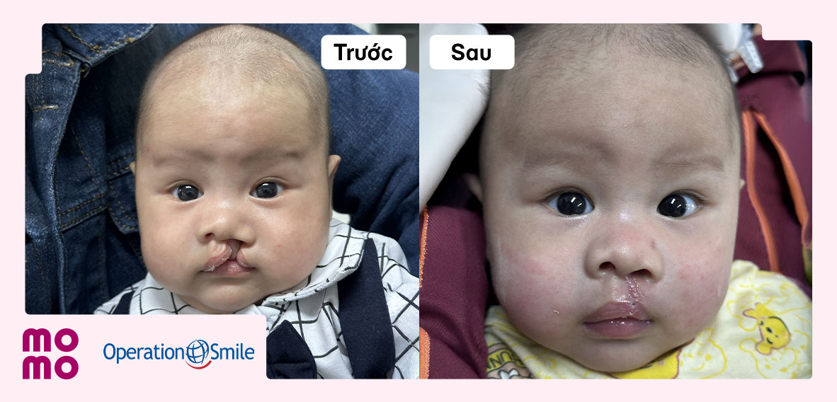 Nhiều ca phẫu thuật miễn phí đã chữa lành nụ cười cho các em nhỏ