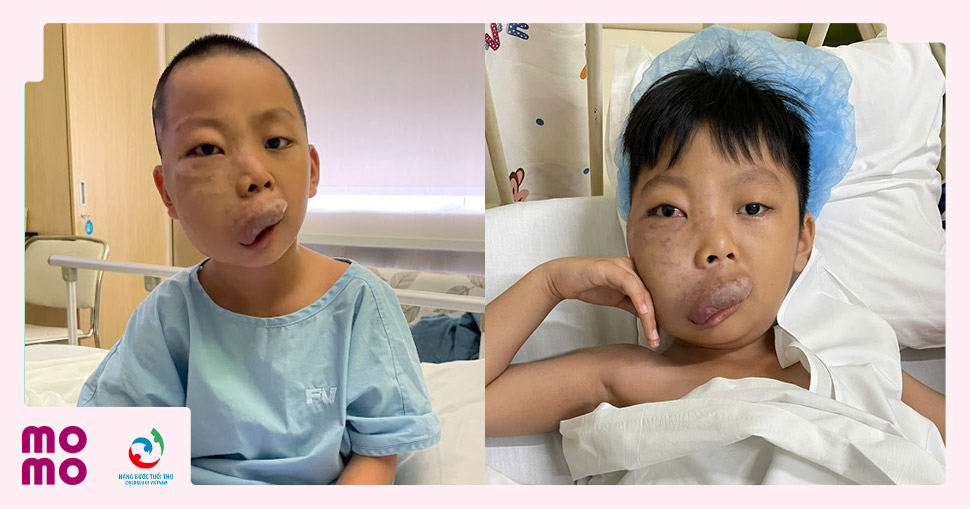 Bé Nguyễn Duy Anh với khuôn mặt nặng nề do dị dạng mạch máu phức tạp