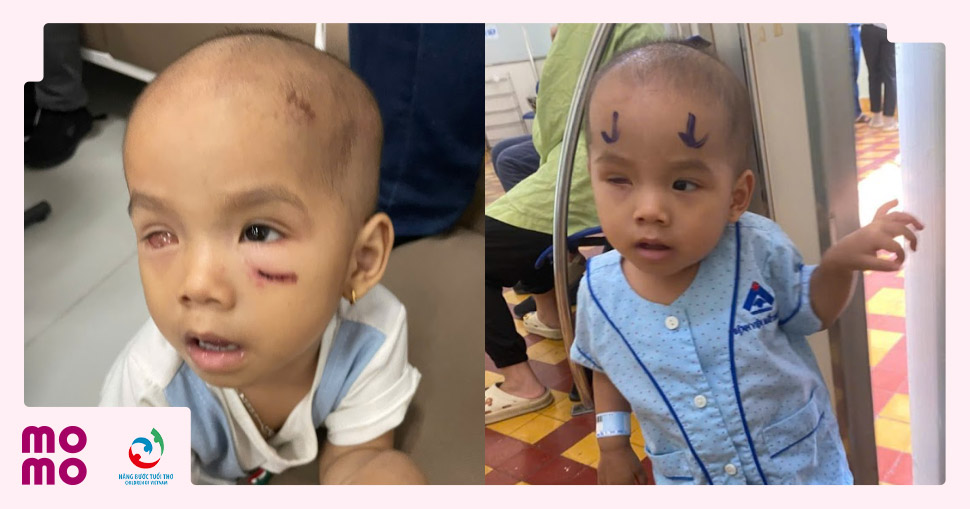 Bé Trịnh Khả Như phải loại bỏ mắt phải do Ung nguyên bào võng mạc