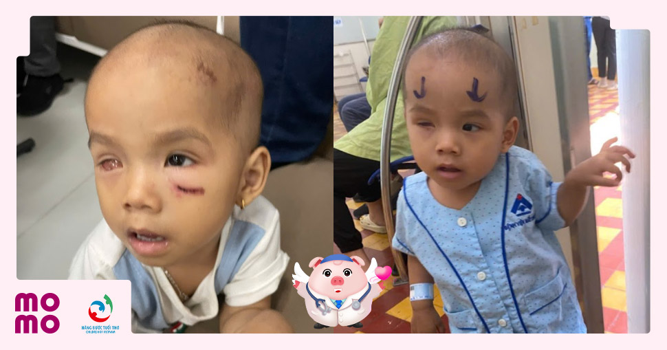Bé Trịnh Khả Như phải loại bỏ mắt phải do Ung nguyên bào võng mạc
