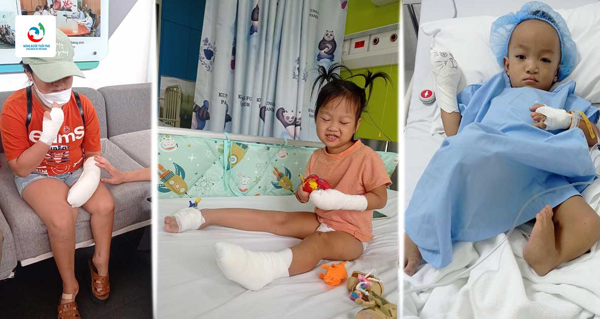  Hình ảnh bé Trần Thị Khánh Ly, Trần Hiền Nhi, Cao Gia Bảo sau khi phẫu thuật dị tật bàn tay