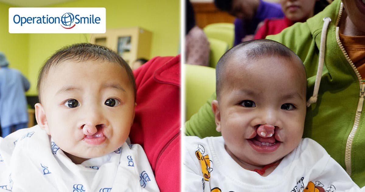 Chung tay gây quỹ 20 ca phẫu thuật cho các em bé hở môi, hàm ếch giúp các em tìm lại nụ cười tự tin.