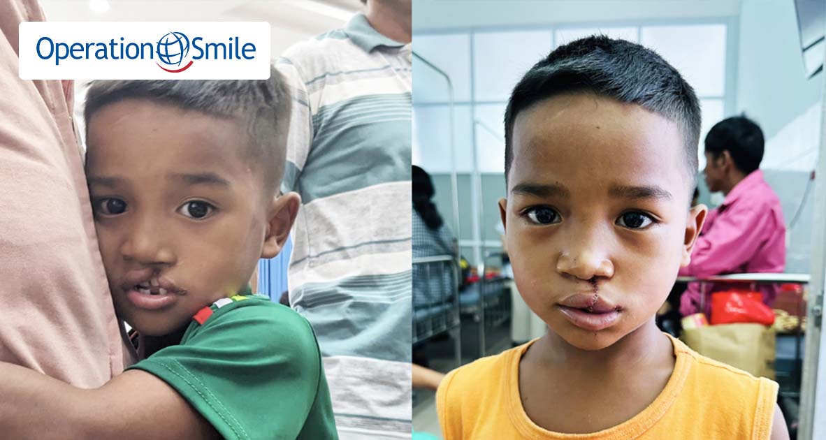 Gây quỹ trao tặng 20 nụ cười cho các bé mắc dị tật hàm mặt trên khắp Việt Nam